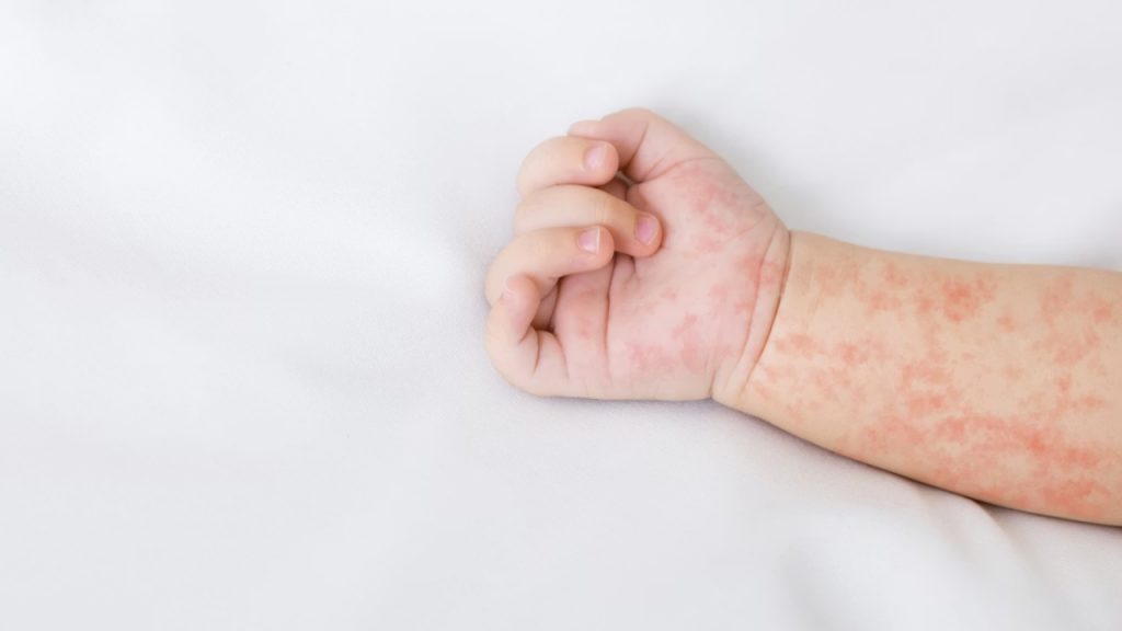 Un bebé de un año murió en Tlaxcala por sarampión; no contaba con la dosis correspondiente de su esquema de vacunación.