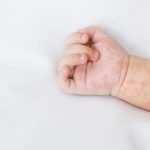 Un bebé de un año murió en Tlaxcala por sarampión; no contaba con la dosis correspondiente de su esquema de vacunación.