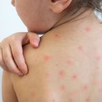 sarampion-infantil-medline-plus