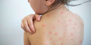 sarampion-infantil-medline-plus