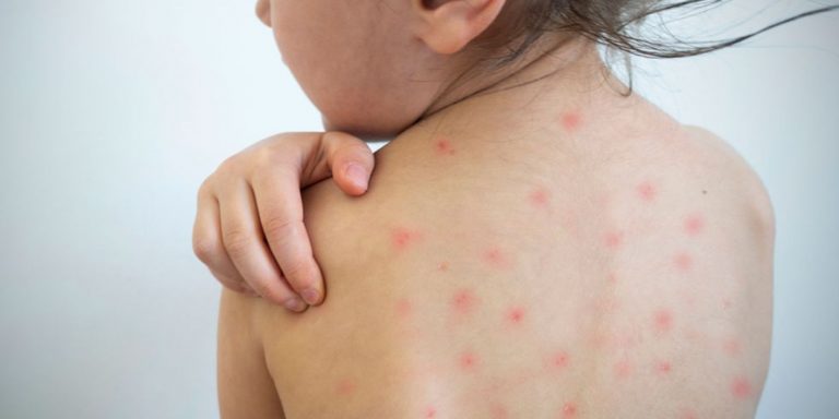 sarampion-infantil-medline-plus